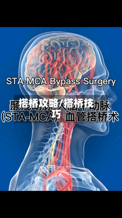 搭桥攻略/搭桥技巧
