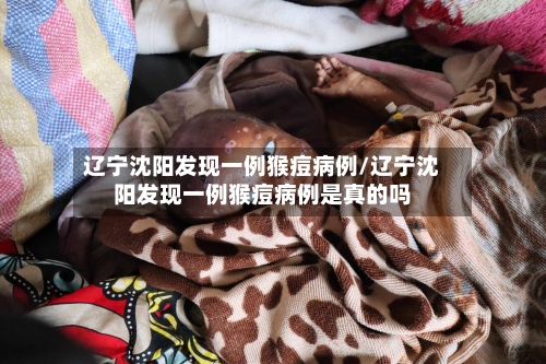 辽宁沈阳发现一例猴痘病例/辽宁沈阳发现一例猴痘病例是真的吗-第3张图片
