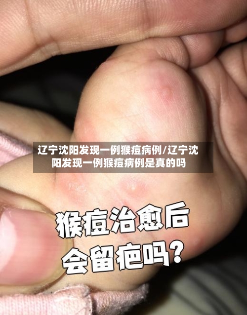 辽宁沈阳发现一例猴痘病例/辽宁沈阳发现一例猴痘病例是真的吗-第2张图片