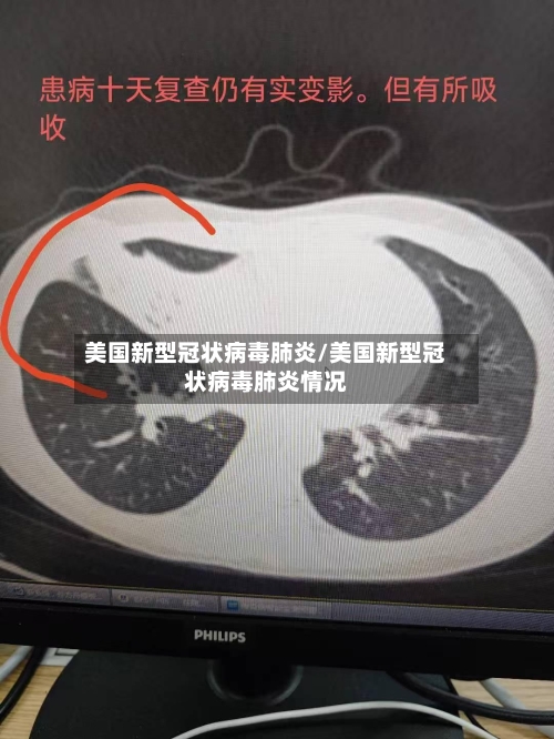 美国新型冠状病毒肺炎/美国新型冠状病毒肺炎情况-第3张图片
