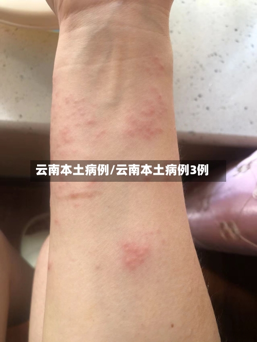 云南本土病例/云南本土病例3例