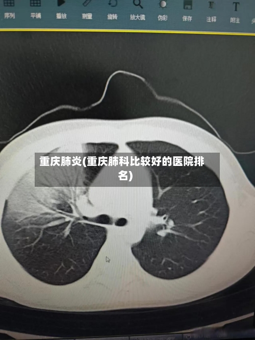 重庆肺炎(重庆肺科比较好的医院排名)-第1张图片