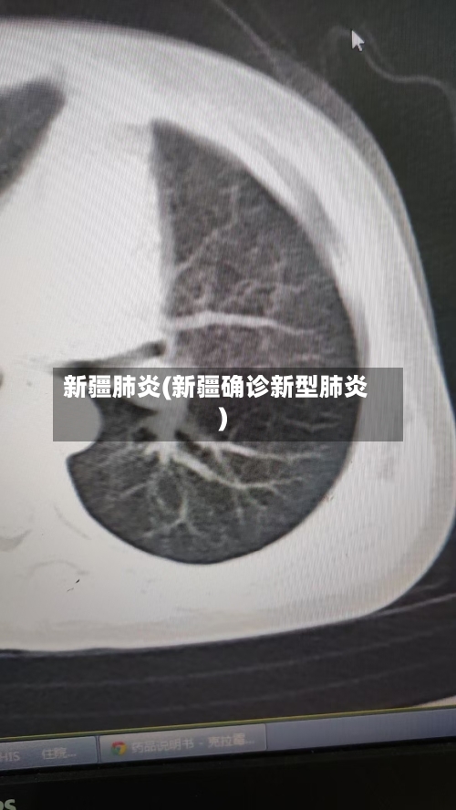 新疆肺炎(新疆确诊新型肺炎)