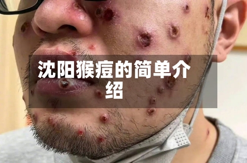 沈阳猴痘的简单介绍-第2张图片