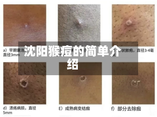 沈阳猴痘的简单介绍-第1张图片