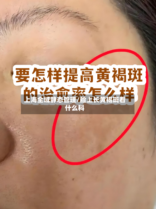 上海全域静态管理/脸上长黄褐斑看什么科-第1张图片