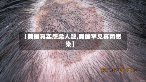 【美国真实感染人数,美国罕见真菌感染】-第2张图片