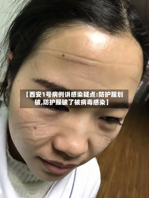 【西安1号病例讲感染疑点:防护服划破,防护服破了被病毒感染】