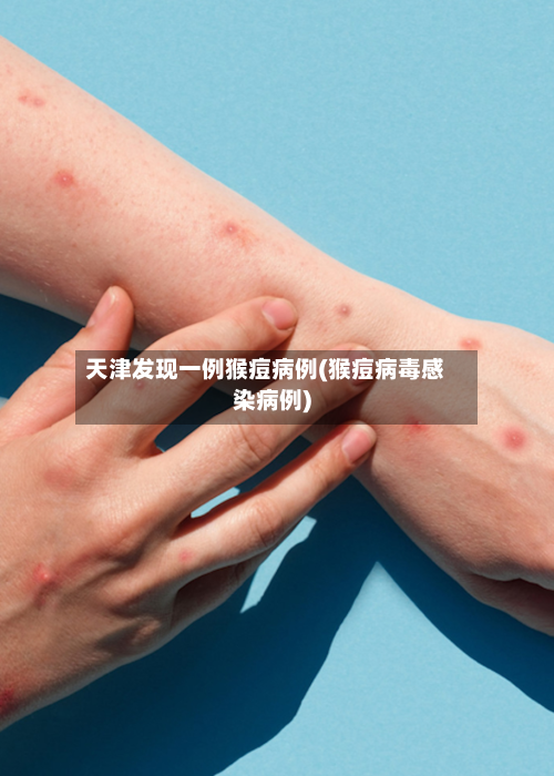 天津发现一例猴痘病例(猴痘病毒感染病例)